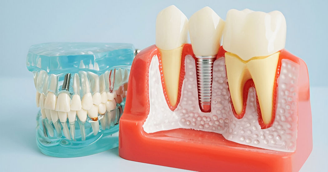 Dental Implants