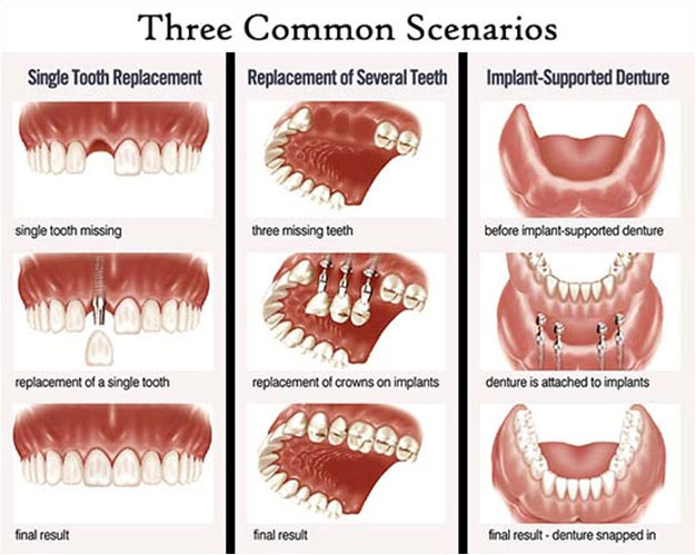 Dental Implants