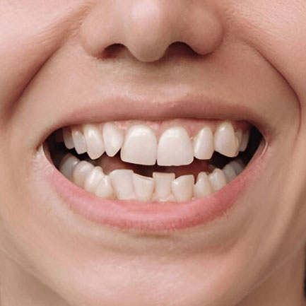 Dental Veneers