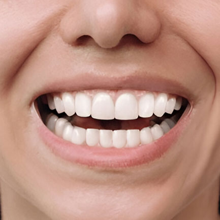Dental Veneers