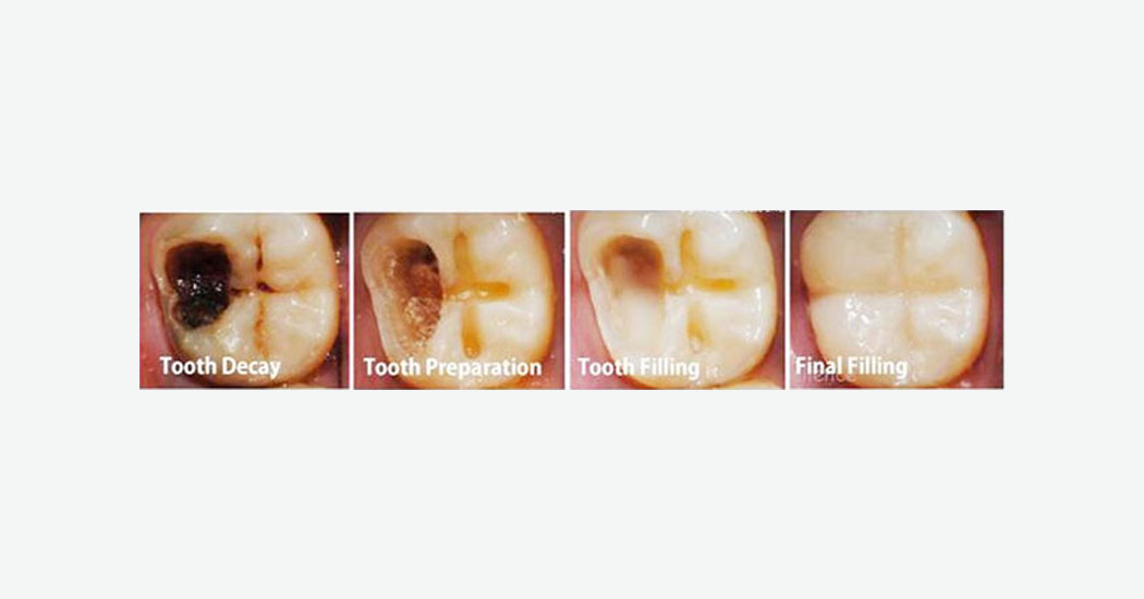 Fillings