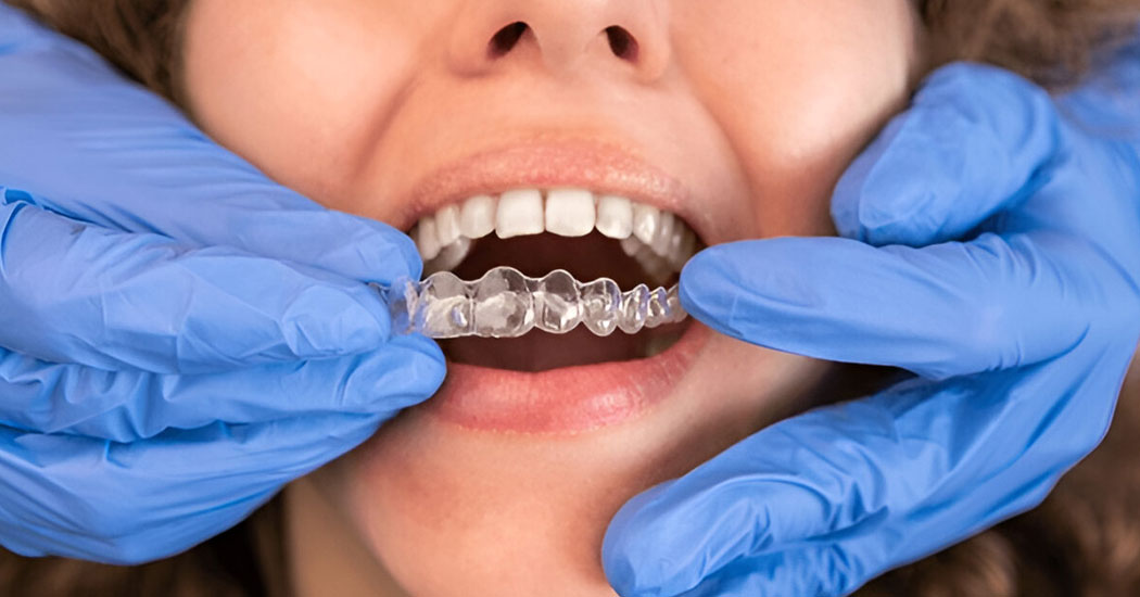 Invisalign Treatment