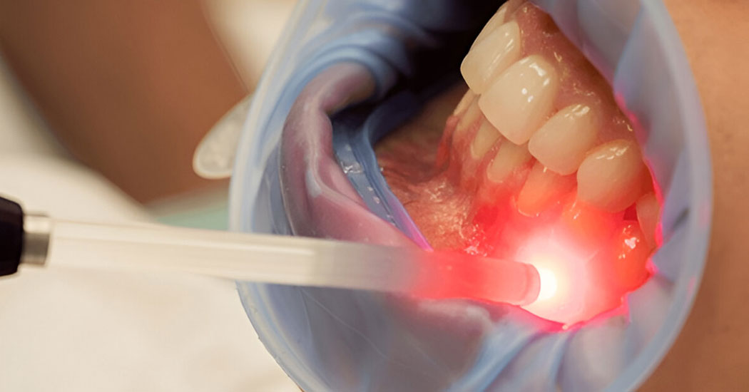Laser Treatment