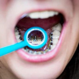 Lingual Braces