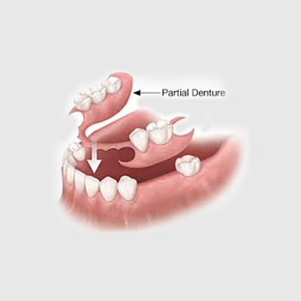 Removable Partial and Complete Dentures