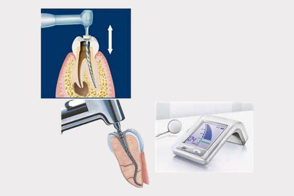 Rotary Endodontics (Rotary RCT)