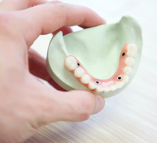 Dental Implants