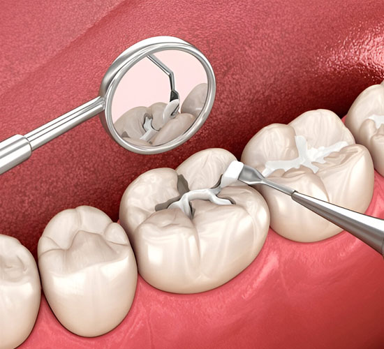 Fillings