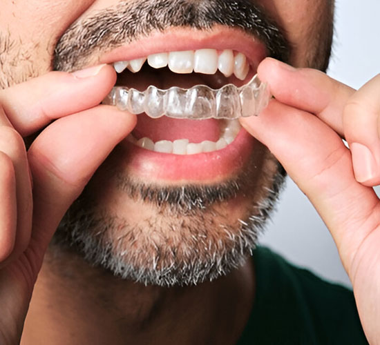 Invisible Braces