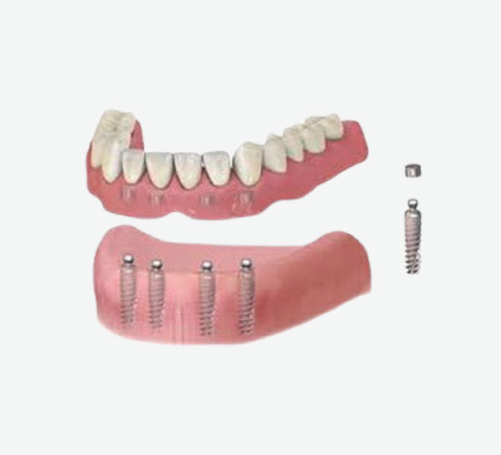 Removable Partial And Complete Dentures
